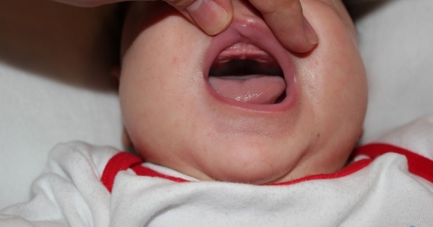 Kas yra gomurio kritimas kūdikiams, kodėl? Simptomai ir gydymas ...