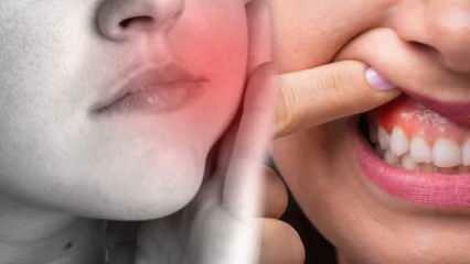 Kas sukelia danties abscesą? Kokie simptomai ir po kiek dienų? Natūralūs dantų absceso sprendimai...