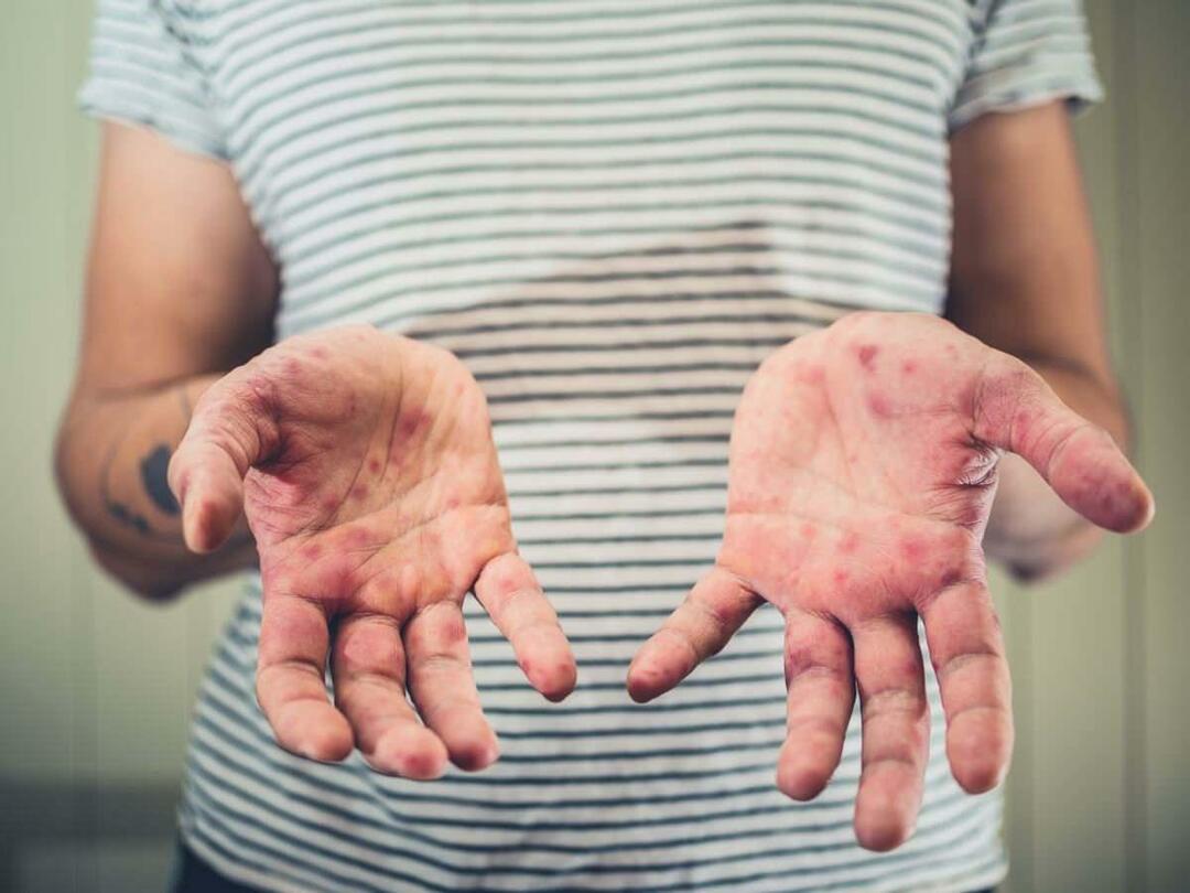 Kokie yra rankų, snukio ir nagų ligos simptomai