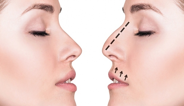 Kaip atliekama nosies operacija? Kokiais atvejais atliekama rinoplastinė operacija?