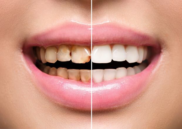 Dėl nesveikos mitybos gali atsirasti dantų spalva ir prarasti dantys