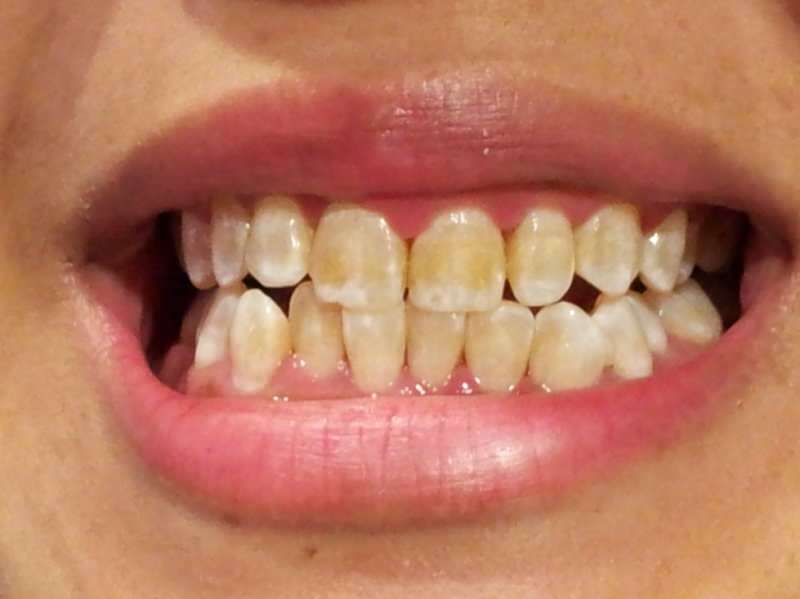 žmogaus, kurio dantys pradeda tamsėti, danties vaizdas