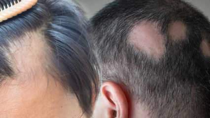 Kas yra grybelis (Alopecia areata)? Kokie yra grybelio simptomai? Veiksmingi grybelio sprendimai