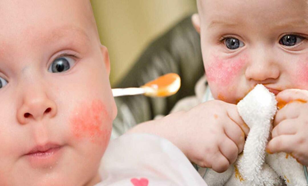 Ką turėtų valgyti alergiškas kūdikis? Kokie yra alternatyvūs maisto produktai alergiškiems kūdikiams?