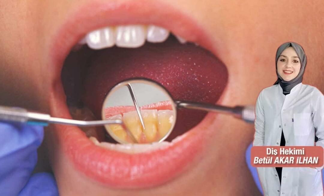 Ką reikėtų daryti norint išvengti dantų akmenų? Kokie yra dantų skalavimo pranašumai?
