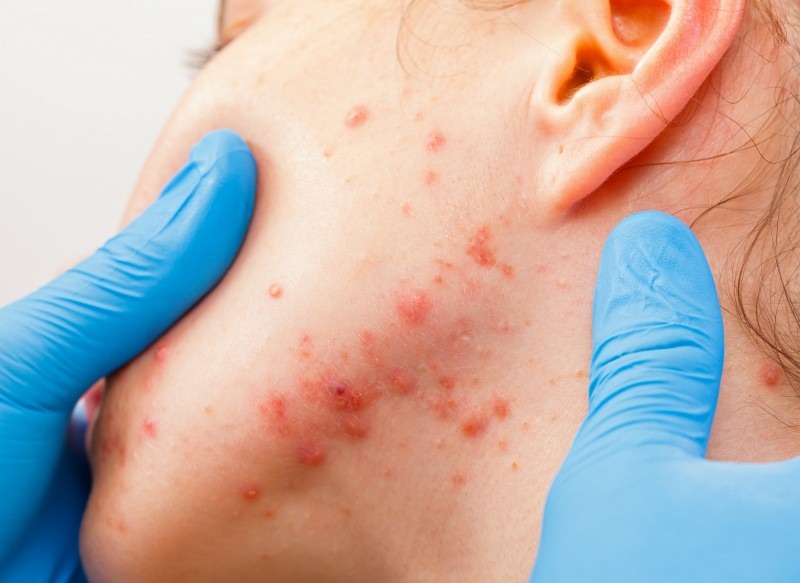 virusas sukelia pūsles ant odos paviršiaus