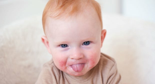 Dėmesio kūdikiams su raudonais skruostais! Pūsto skruosto sindromas ir jo simptomai