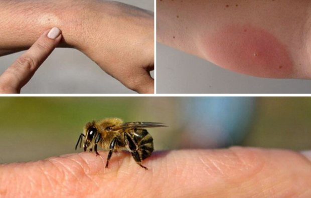bičių alergijos simptomai