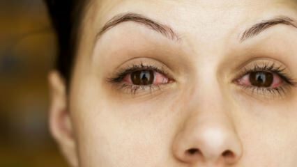 Kas yra konjunktyvitas (akių gripas) ir kokie simptomai? Kaip perduodamas konjunktyvitas?