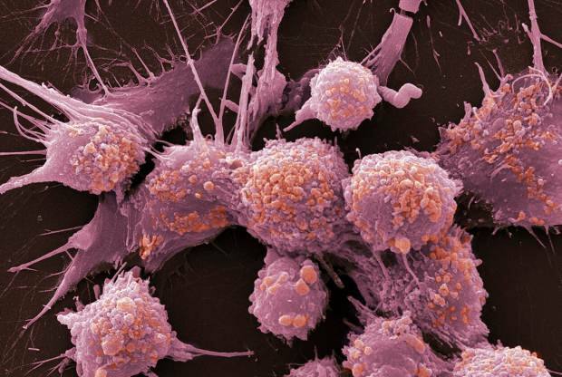 Kas yra vėžys ir kokie jo simptomai? Kiek yra vėžio rūšių? Kaip užkirsti kelią vėžiui?