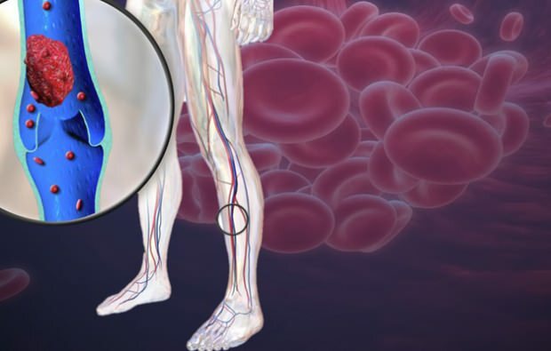 sumažėjusi kraujotaka kojų venose sukelia skausmą